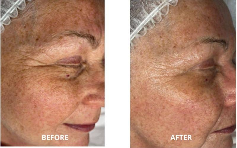 Carboxytherapy Before and Afters