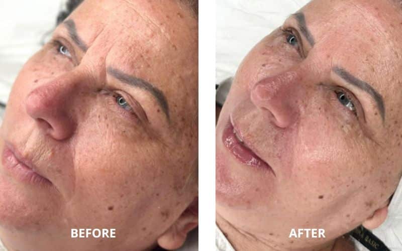 Carboxy facial before and after
