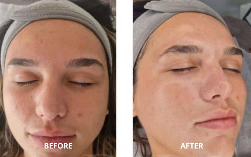 CLINICCARE Cinderella facial - before and after