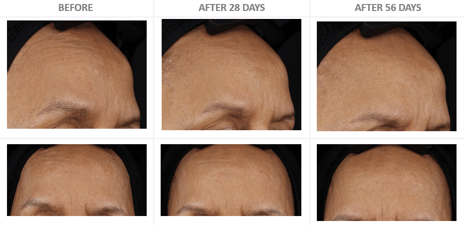 Before and After wrinkles with Cebelia T10