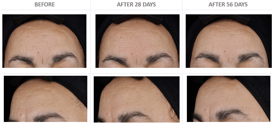 Cebelia - before and after with T10