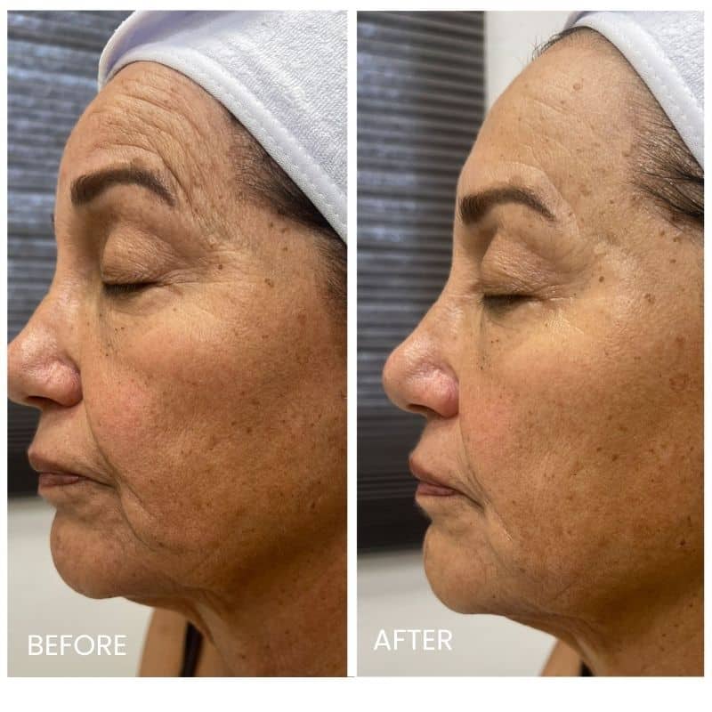 Apollo-Quattro-Before-After