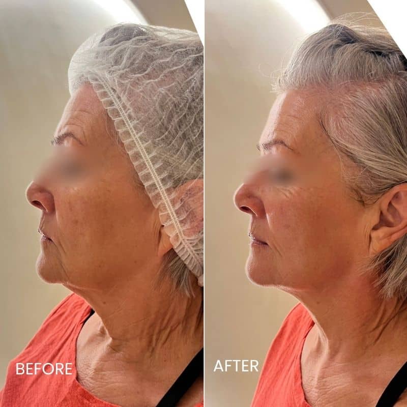 Apollo-Quattro-Before-After